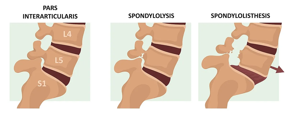 Picture of normal spine, spondylolysis, and spondylolisthesis
