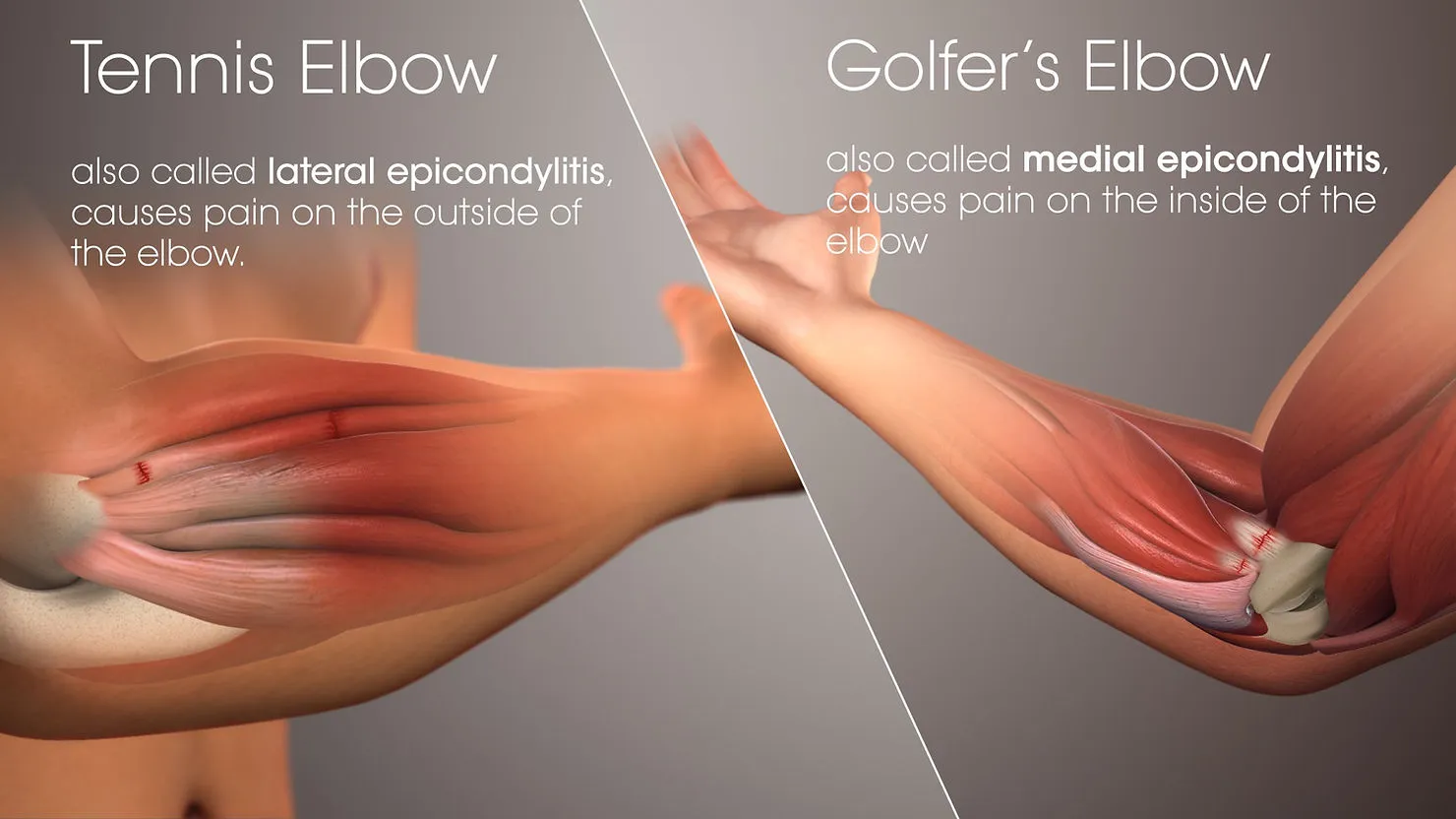 Picture demonstrating tennis elbow and golfer's elbow