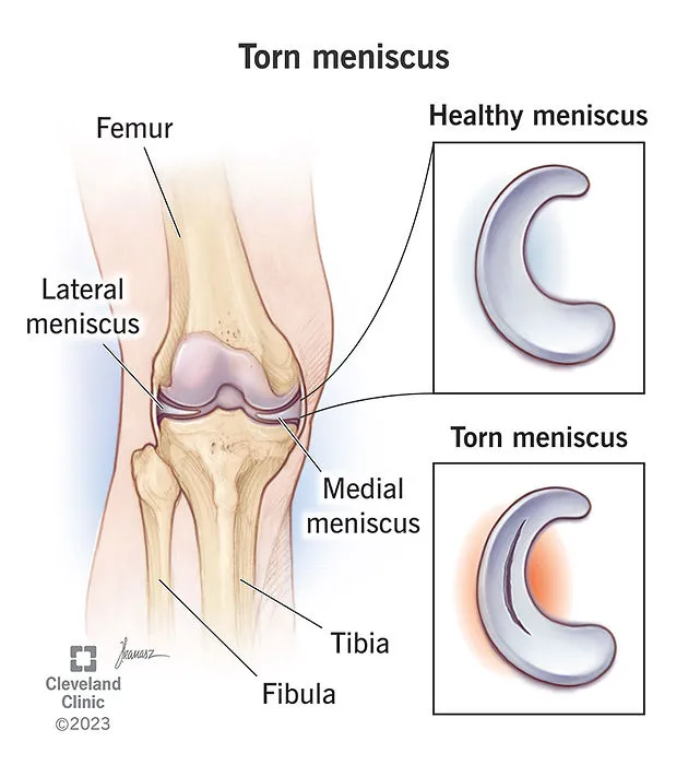 Animated image of knee demonstrating healthy and torn meniscus