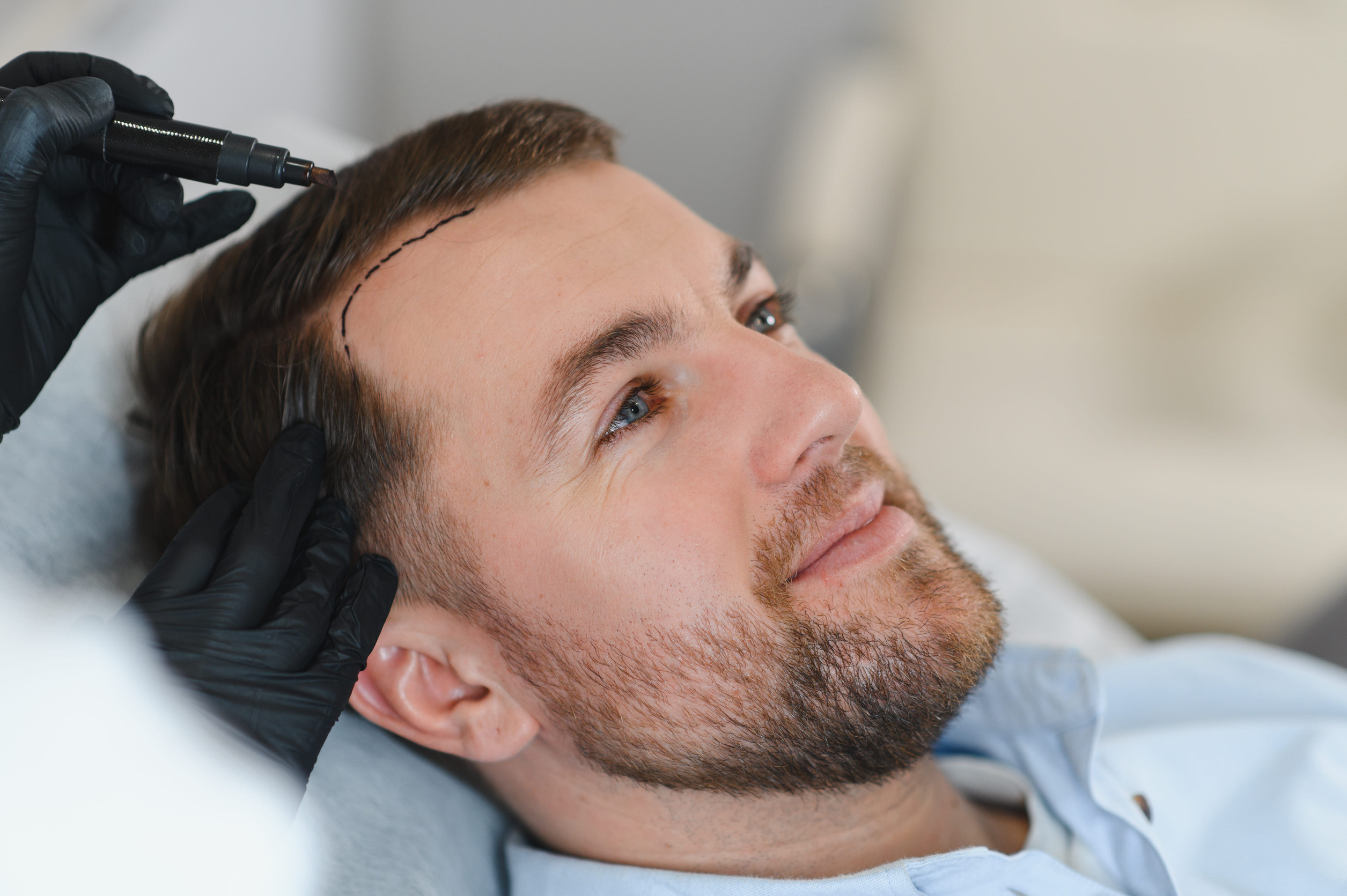 Un uomo che si sottopone ad un trapianto di capelli