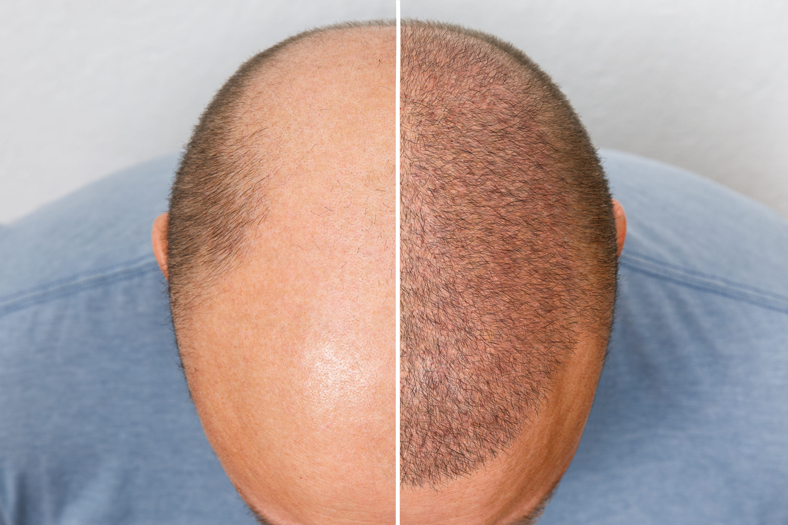 I risultati del trapianto di capelli