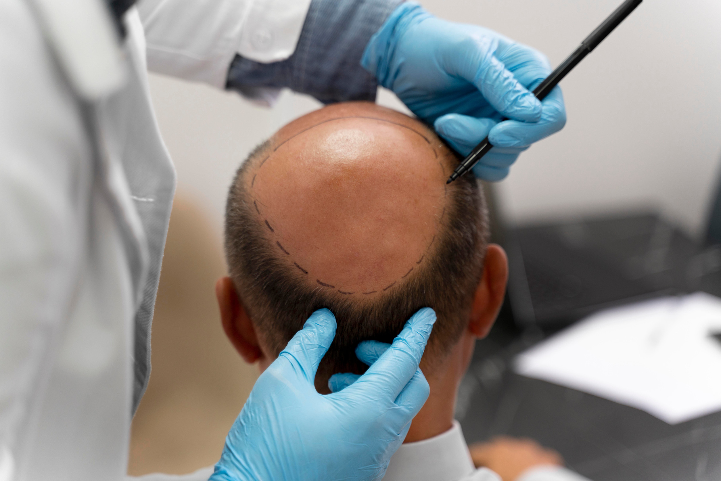 Un paziente viene preparato al trapianto di capelli