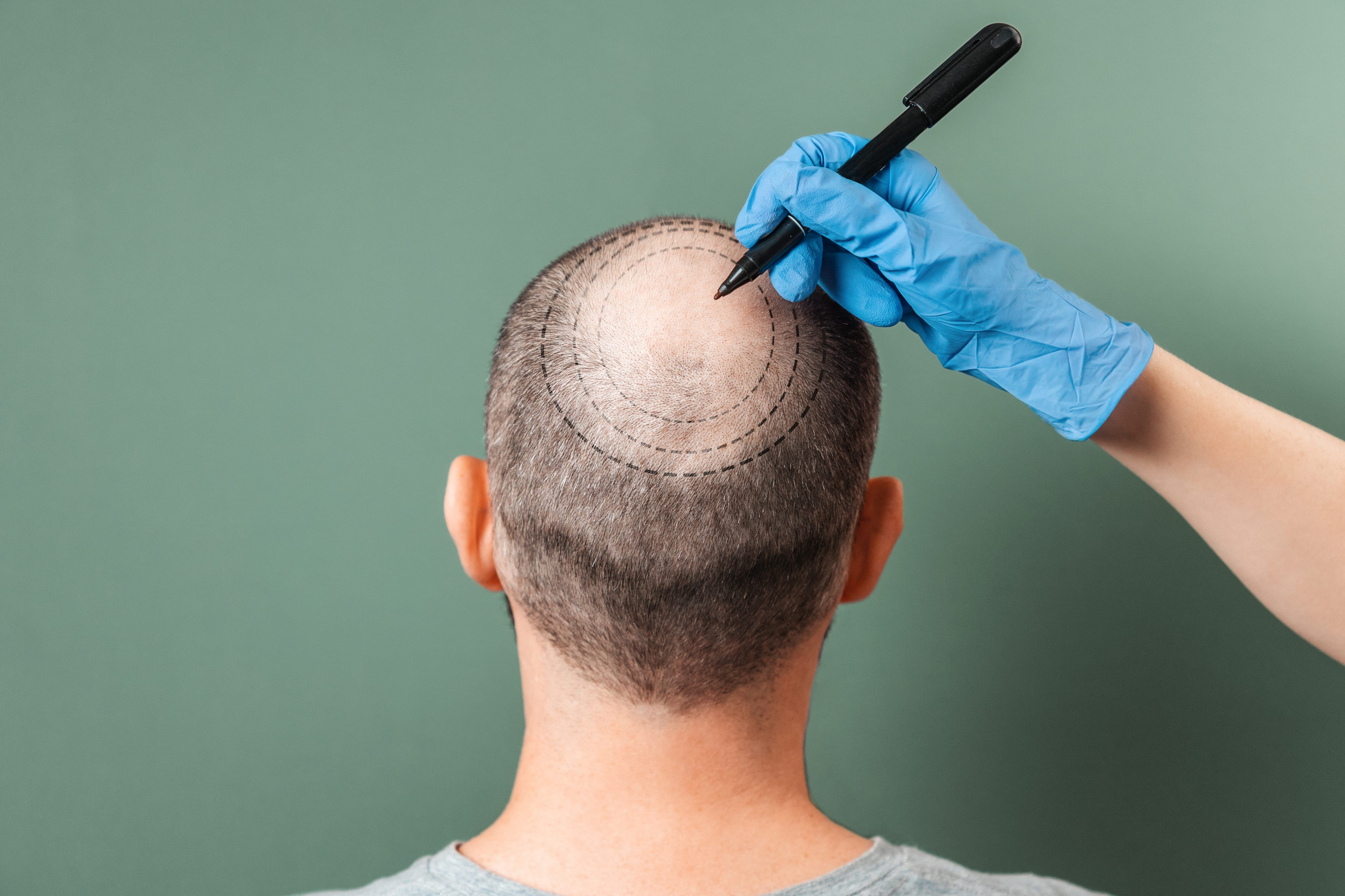 Il disegno prima di un trapianto di capelli