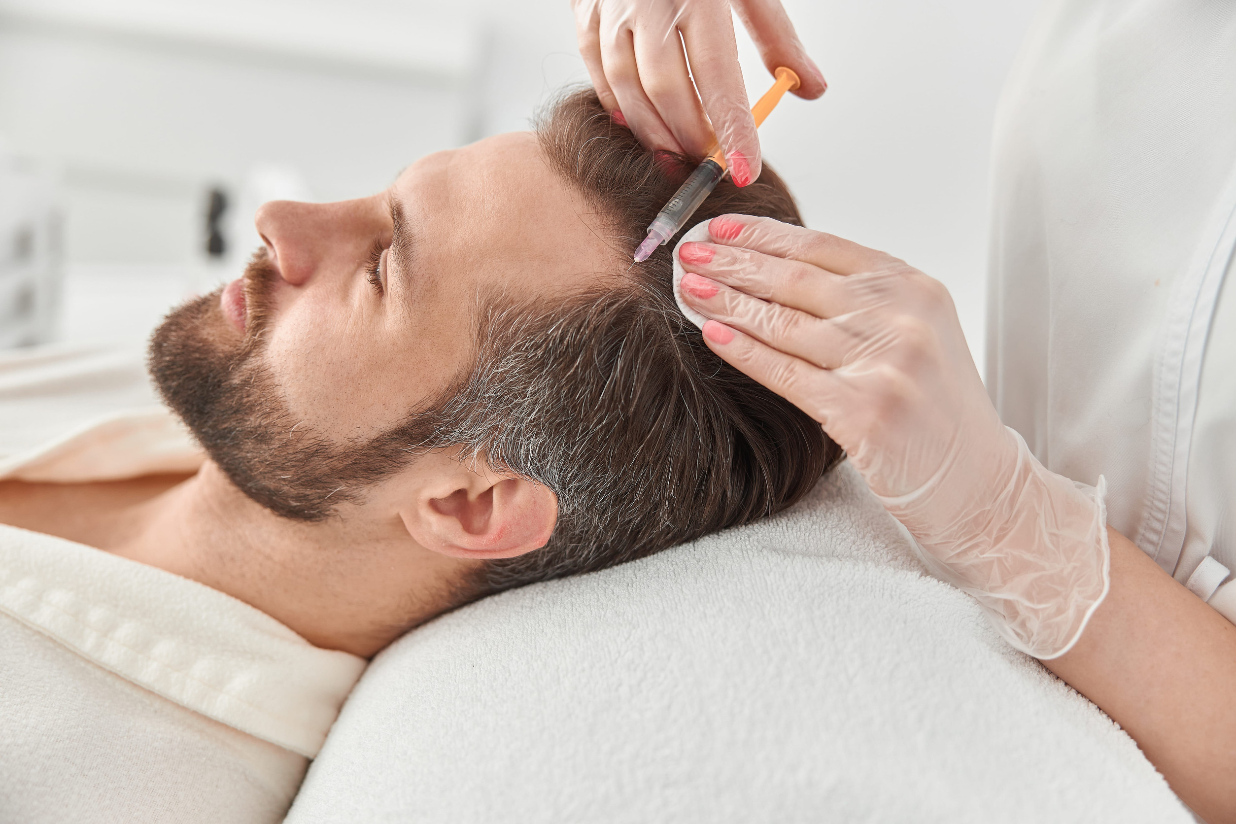 Un trapianto di capelli per una leggera stempiatura