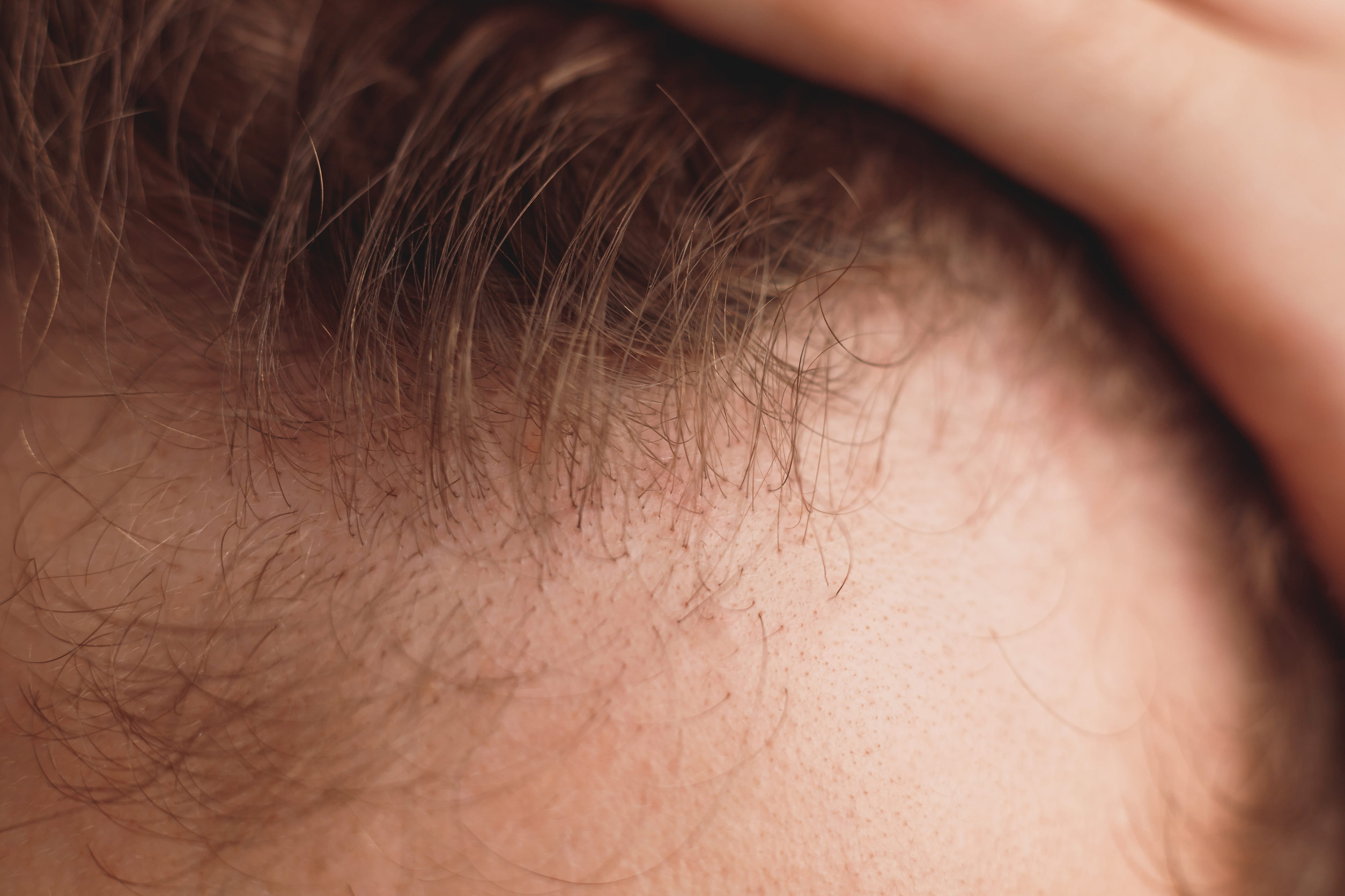 Una chioma che si deve sottoporre a trapianto di capelli