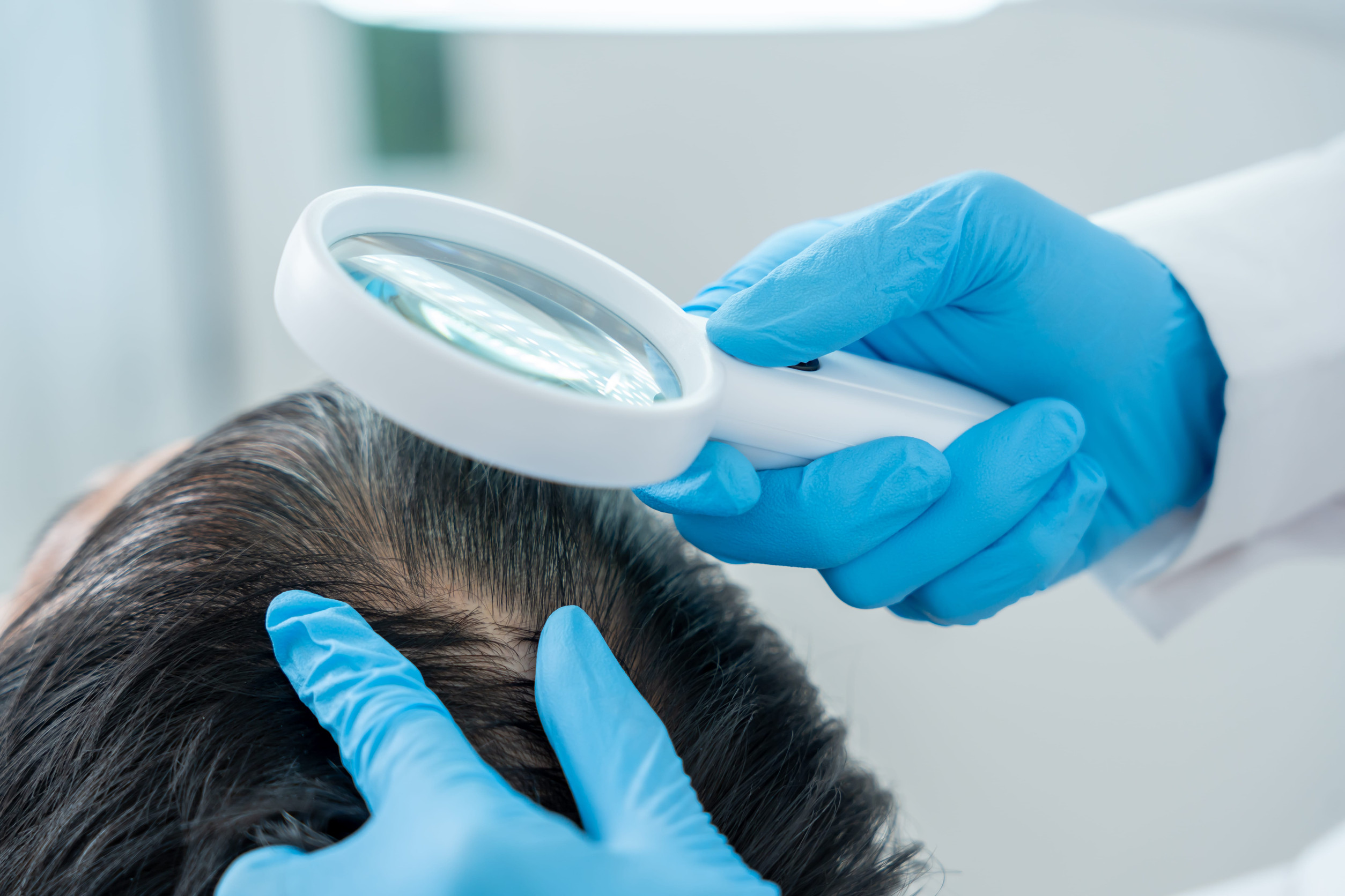 Analisi per vedere come crescono i capelli trapiantati