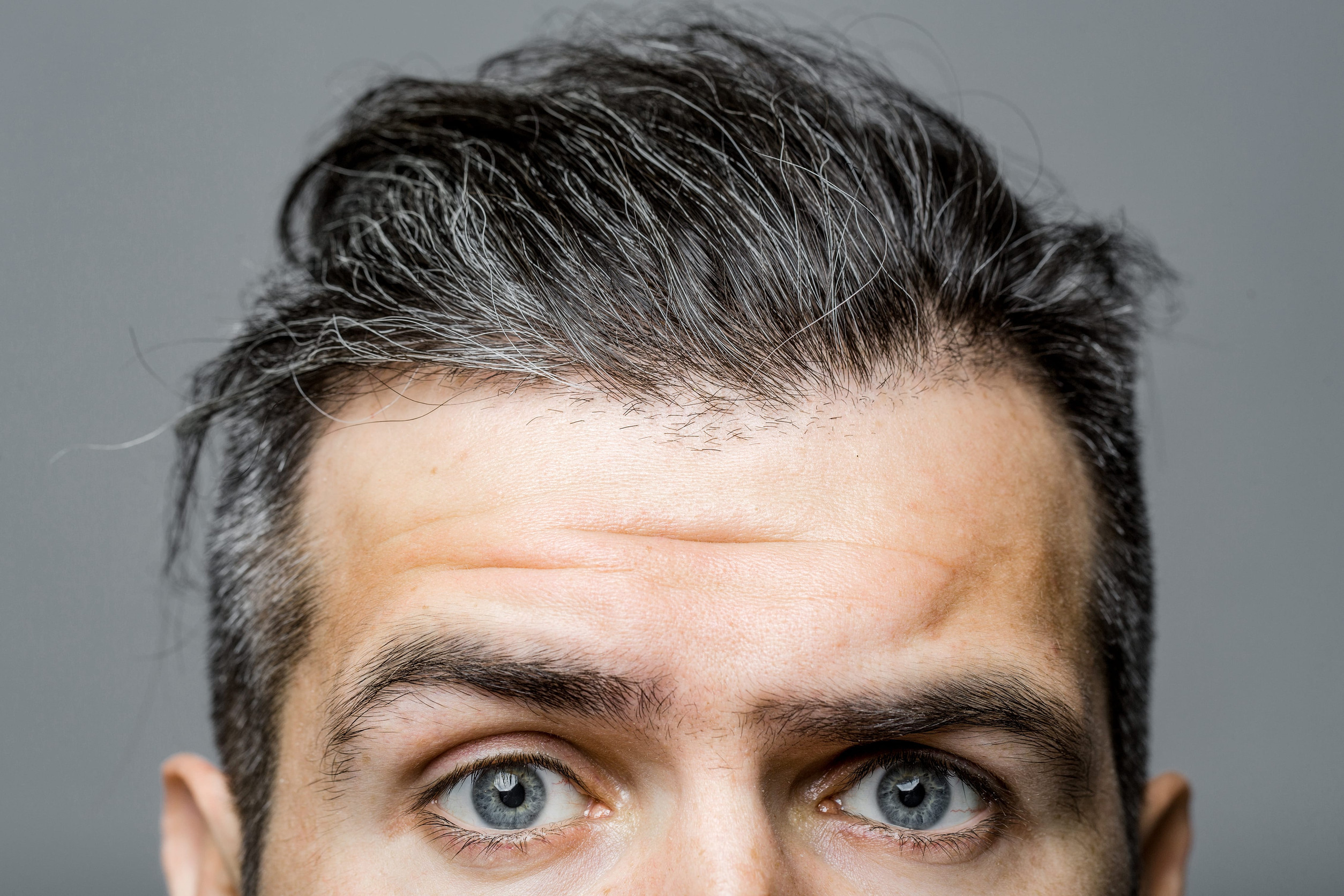 Un uomo 10 anni dopo il trapianto di capelli