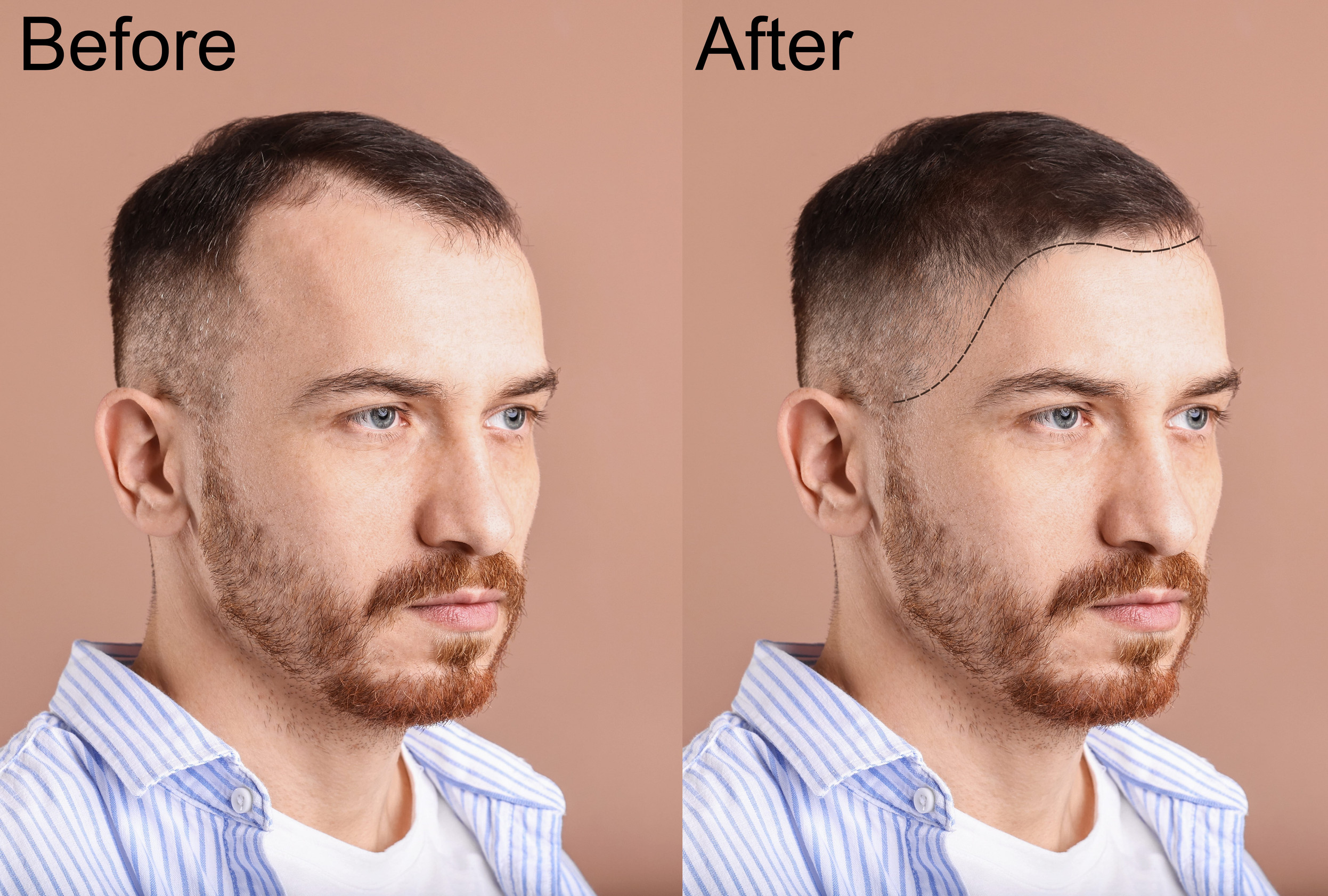 Prima e dopo un trapianto di capelli con tecnica dhi