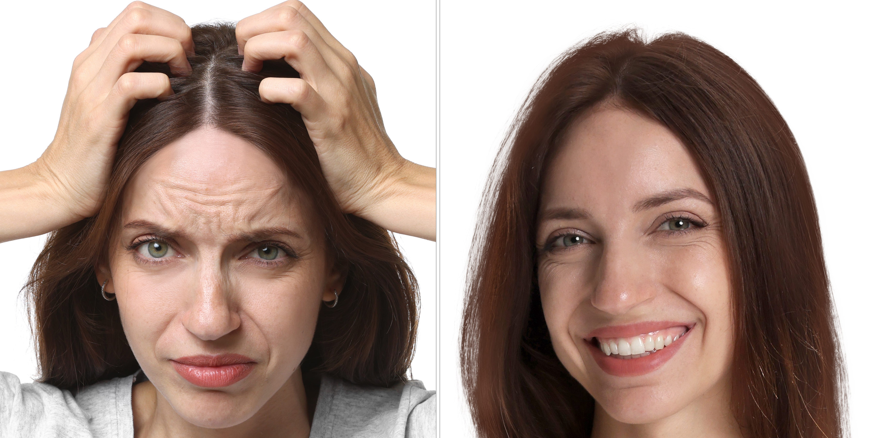 Prima e dopo un trapianto di capelli per una donna