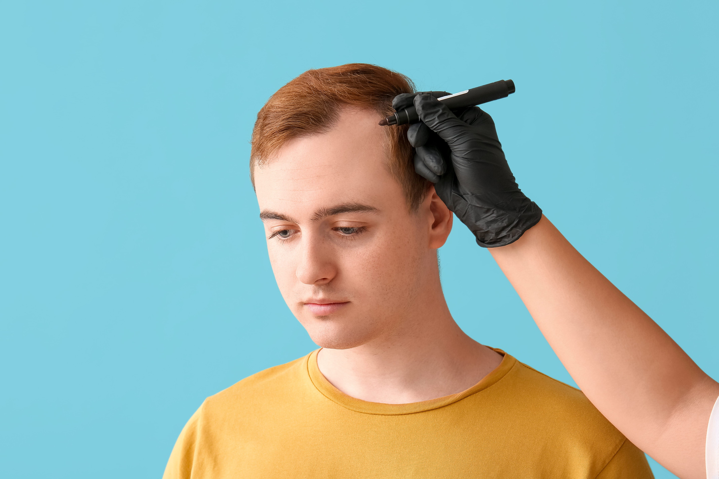 Un giovane che si è chiesto a che età potrà fare un trapianto di capelli
