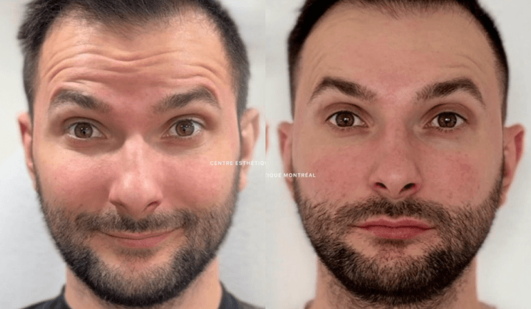 Botox treatment before and after results at Centre Esthétique Montréal