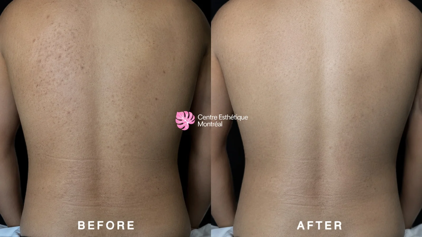 Before and after a back facial showing clearer skin with fewer blemishes on the upper back