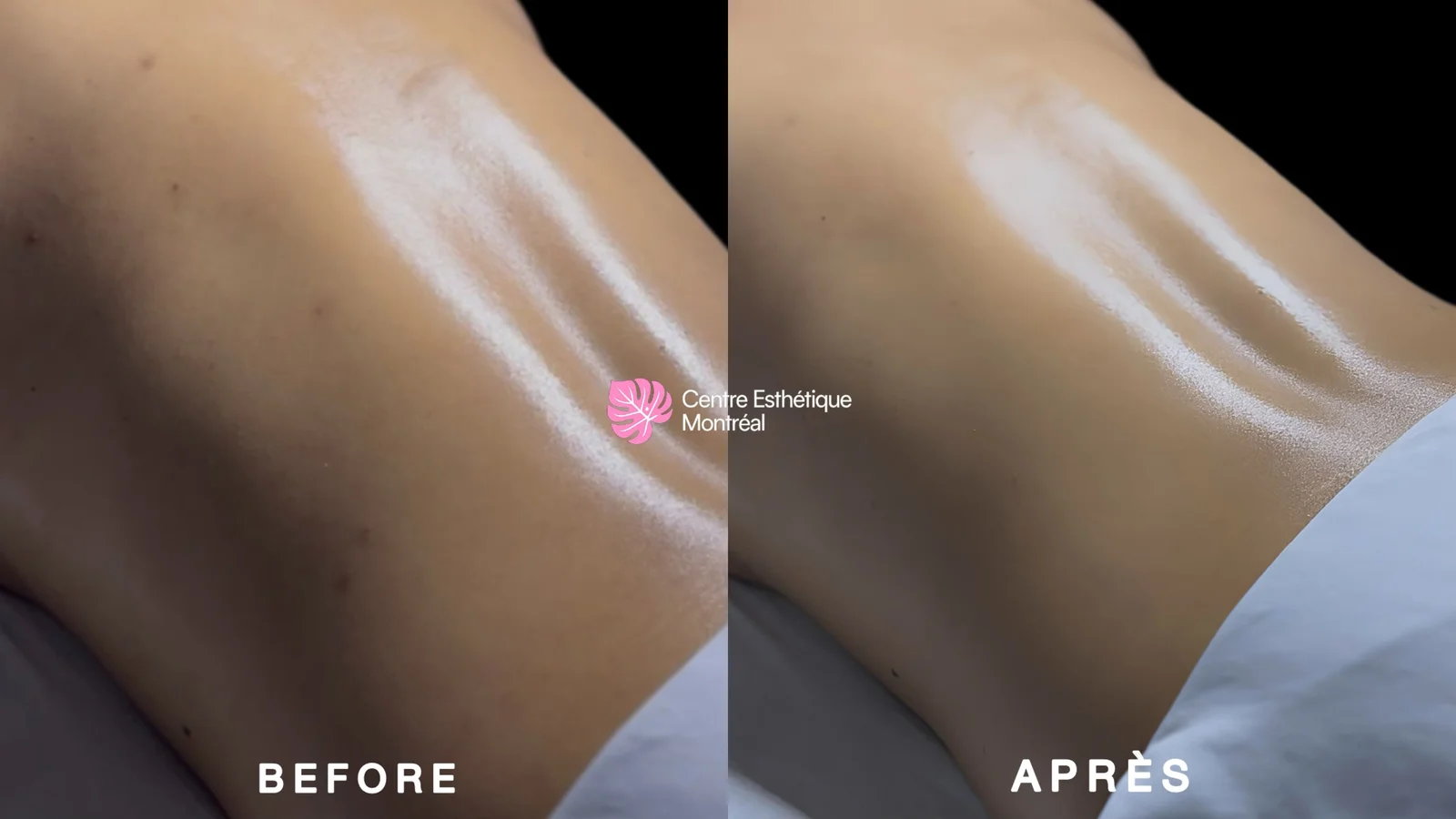 Close-up before and after a back facial on the lower back, with smoother and more even skin
