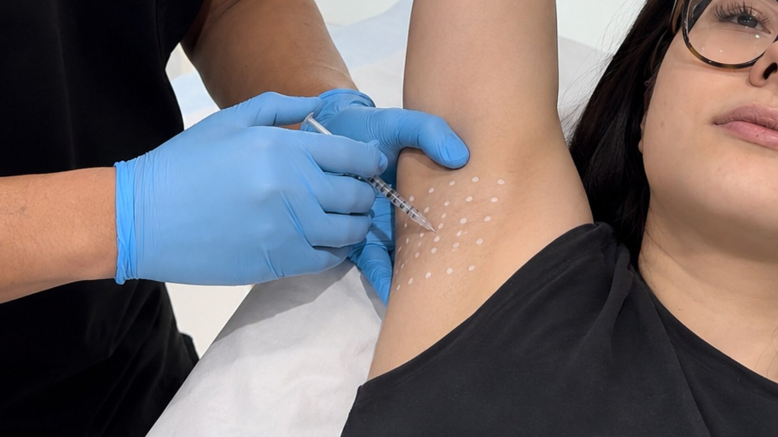 Micro-injection of botulinum toxin into a mapped underarm during a hyperhidrosis treatment