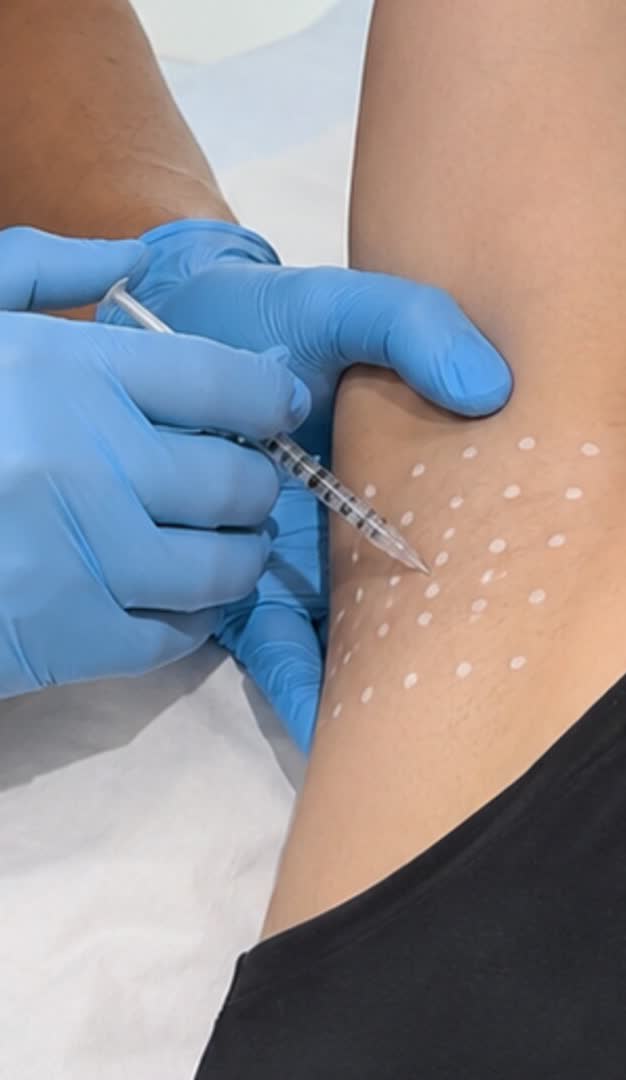 Hyperhidrosis treatment at Centre Esthétique Montréal