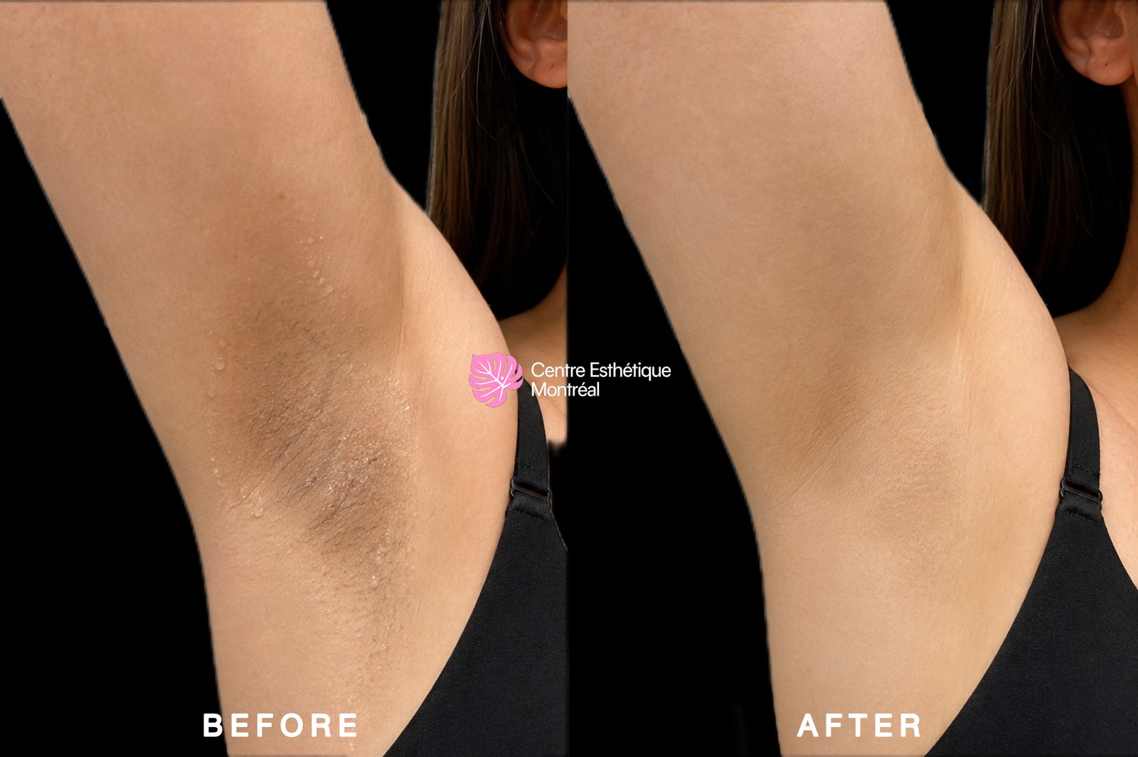 Hyperhidrosis treatment at Centre Esthétique Montréal before and after results
