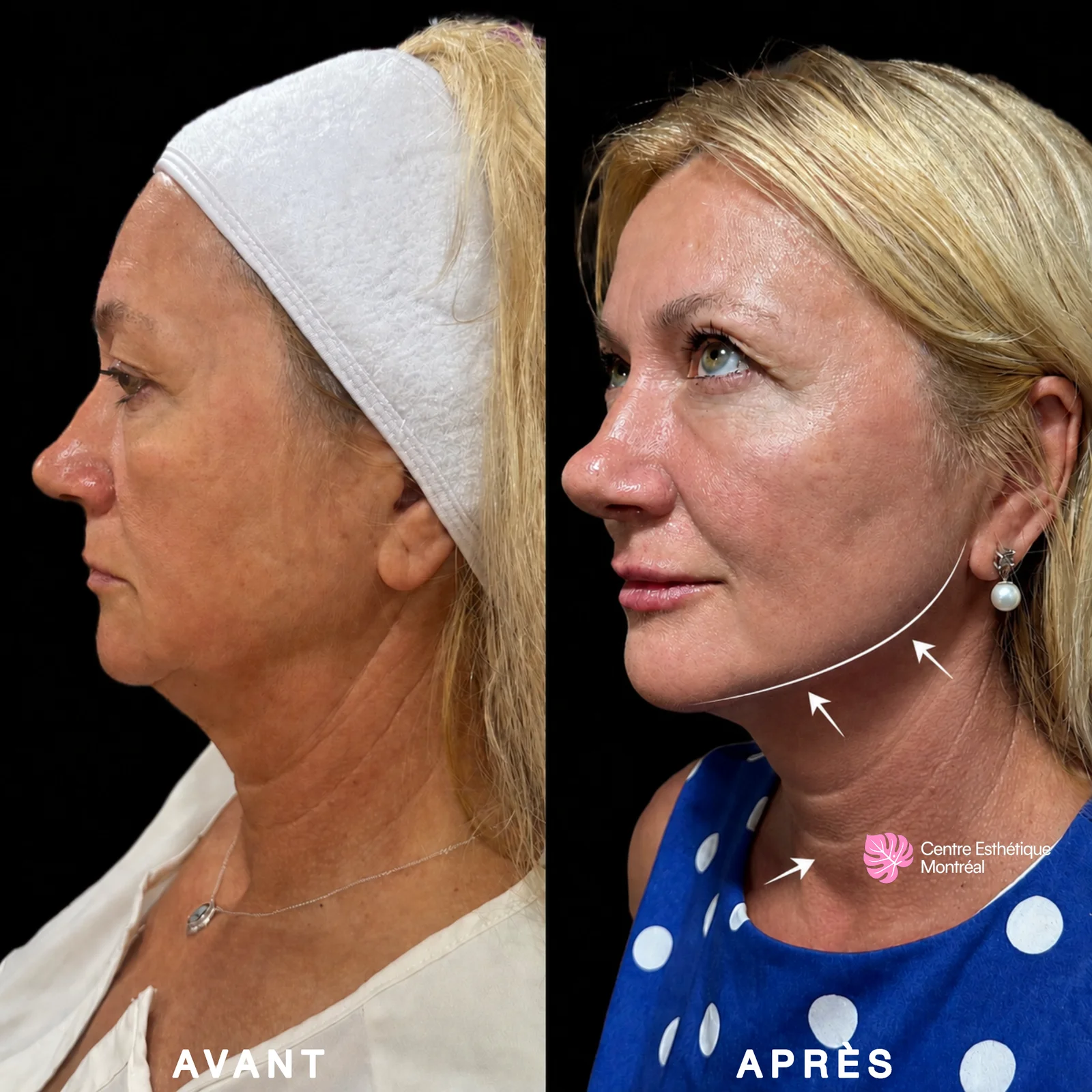 Before and after jawline slimming results showing a more refined and better defined lower face in profile