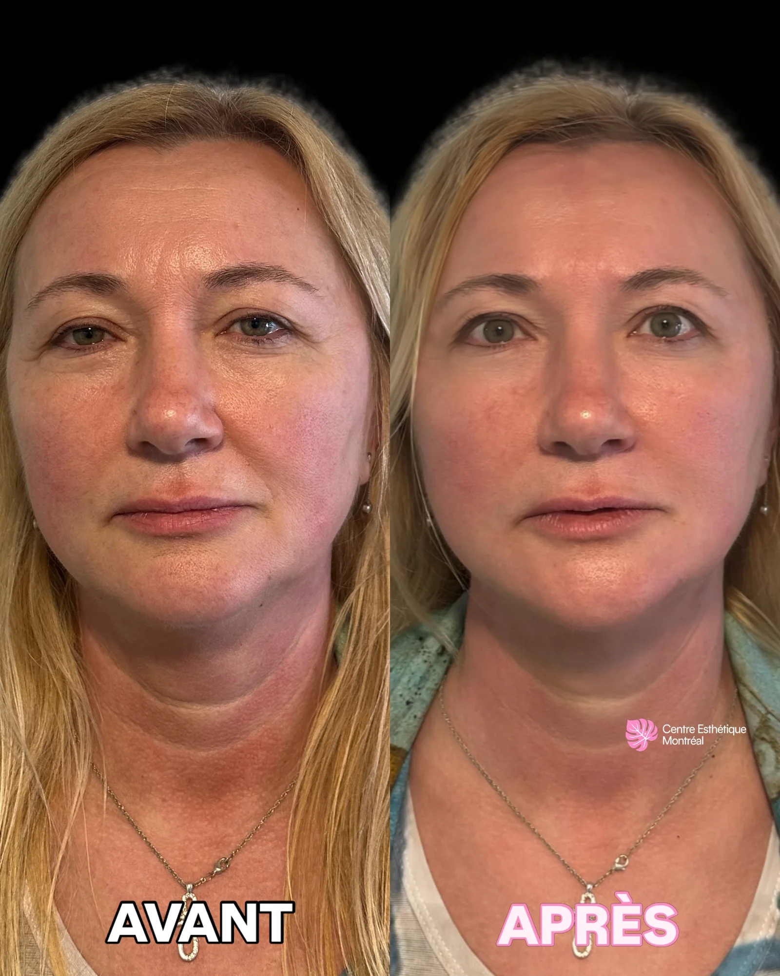 Résultats avant et après un skin booster, avec une peau du visage plus lisse, lumineuse et hydratée