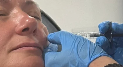 Injection d'un agent de comblement dans la joue par un médecin au Centre Esthétique Montréal