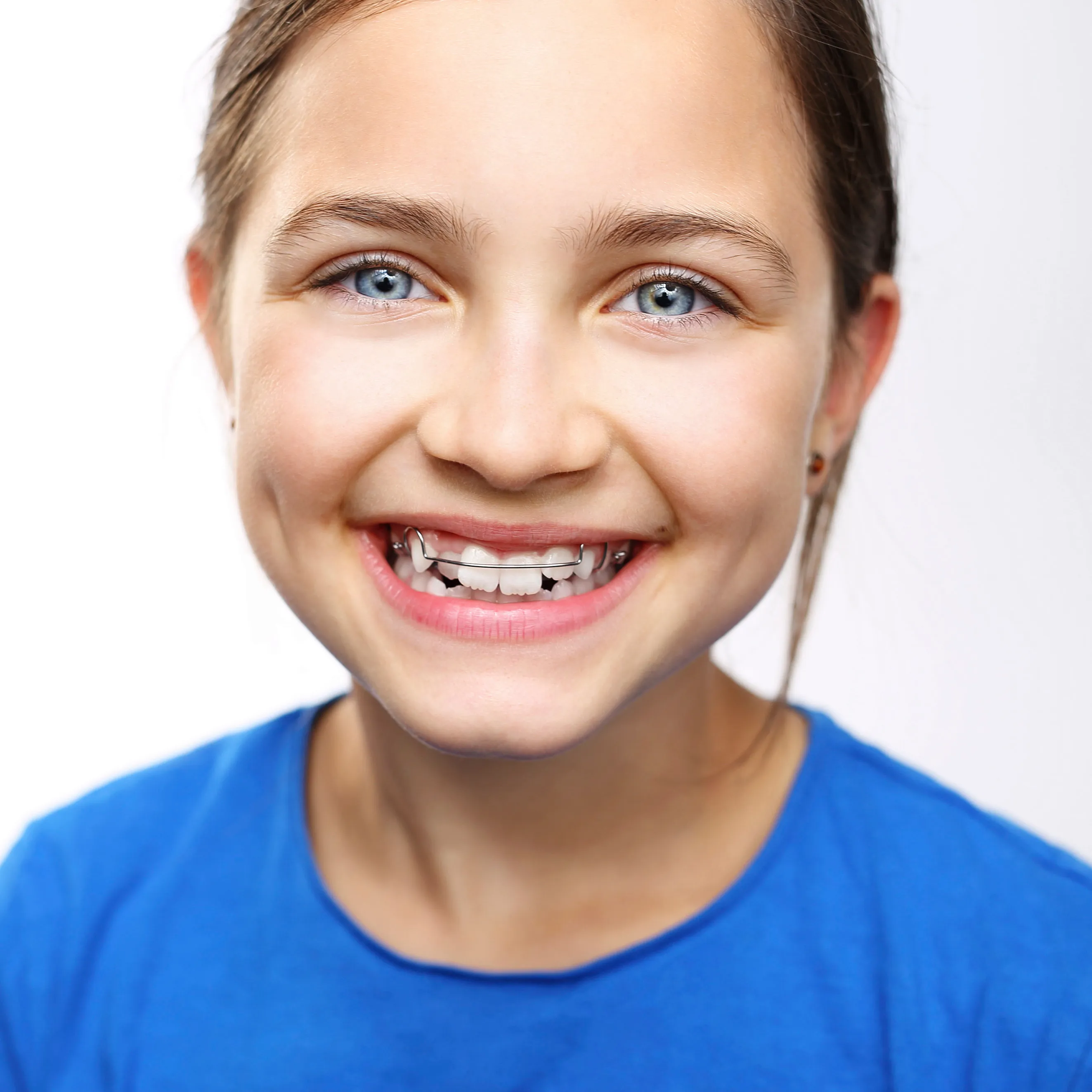 Close-up of a smile with braces