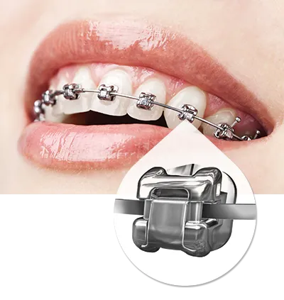 Damon System self-ligating braces