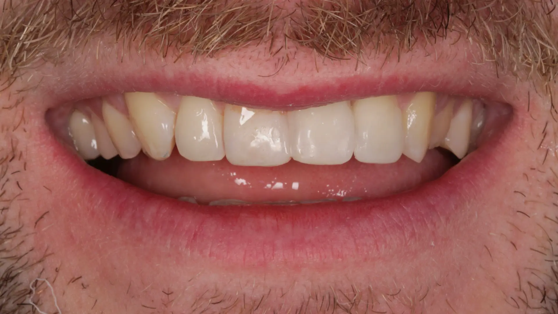 Even, uniformly shaped front teeth after cosmetic reshaping treatment