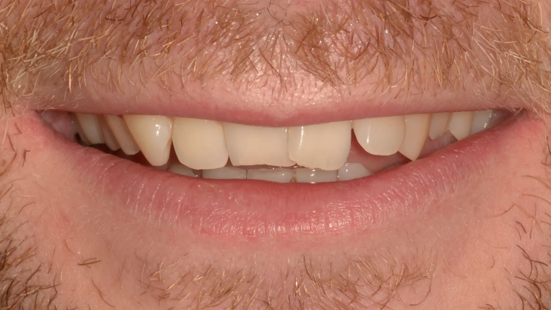 Uneven, chipped front teeth before cosmetic reshaping treatment