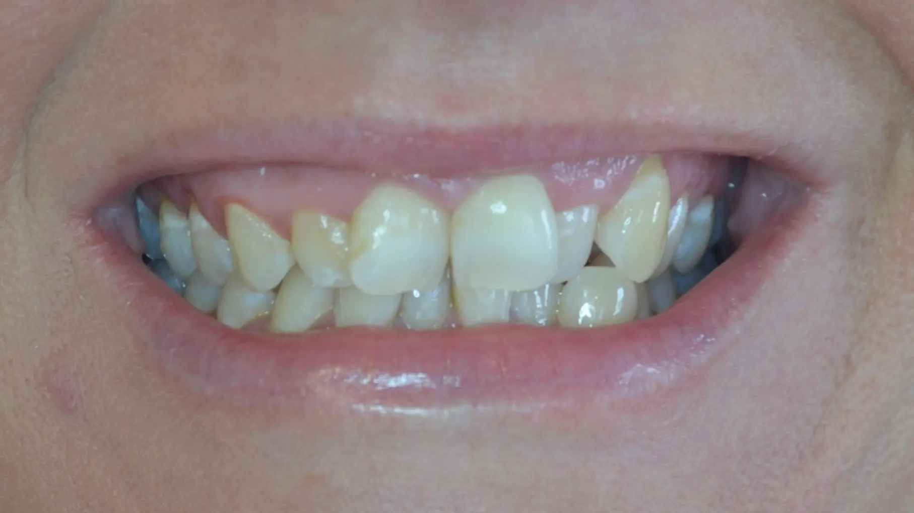 Discoloured, uneven teeth before cosmetic treatment