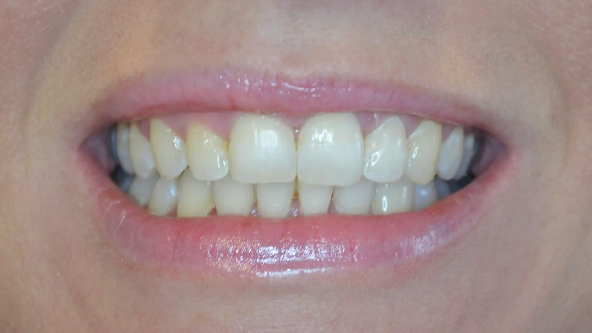 Brighter, more even teeth after cosmetic treatment