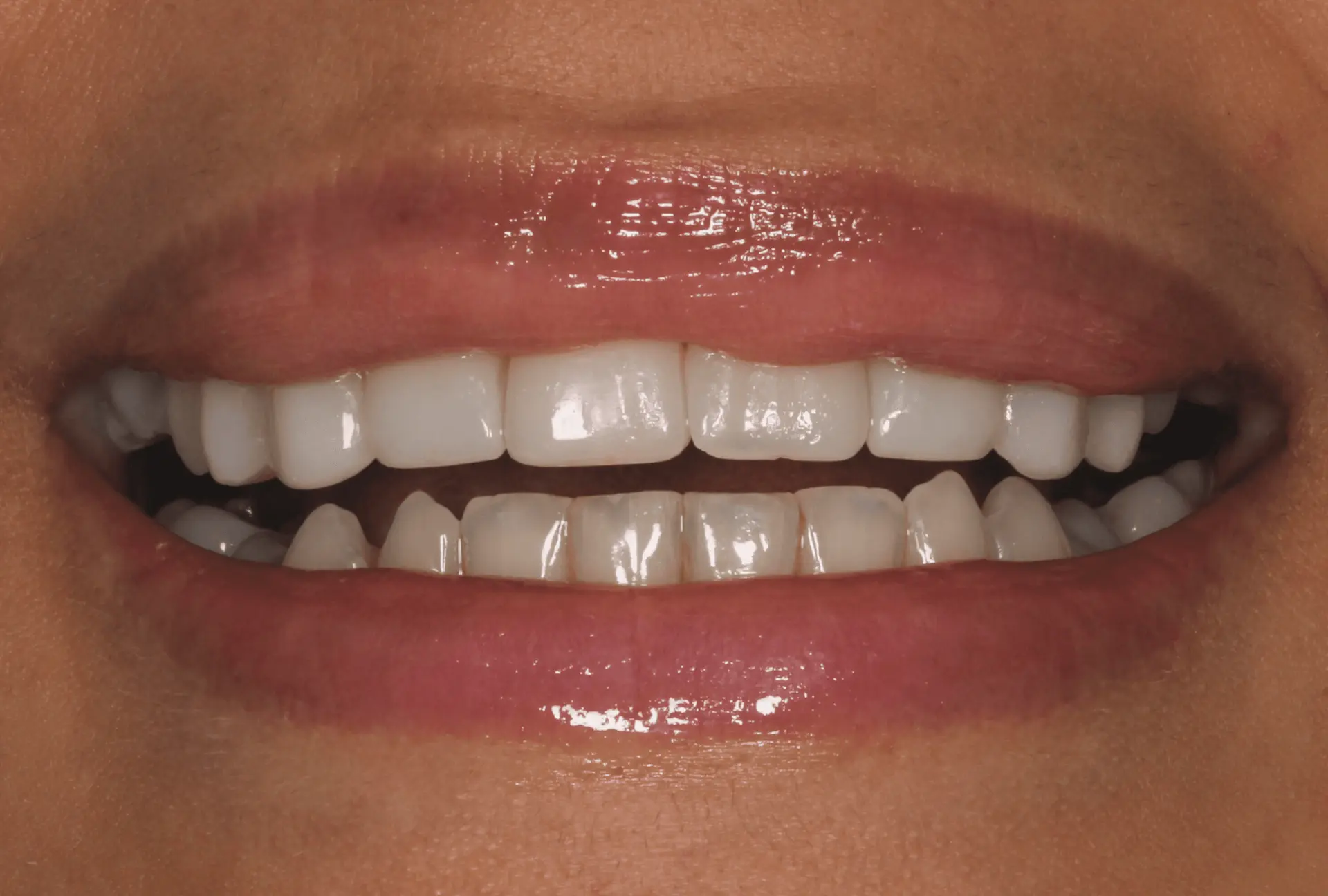 Gap between the front teeth closed after composite bonding