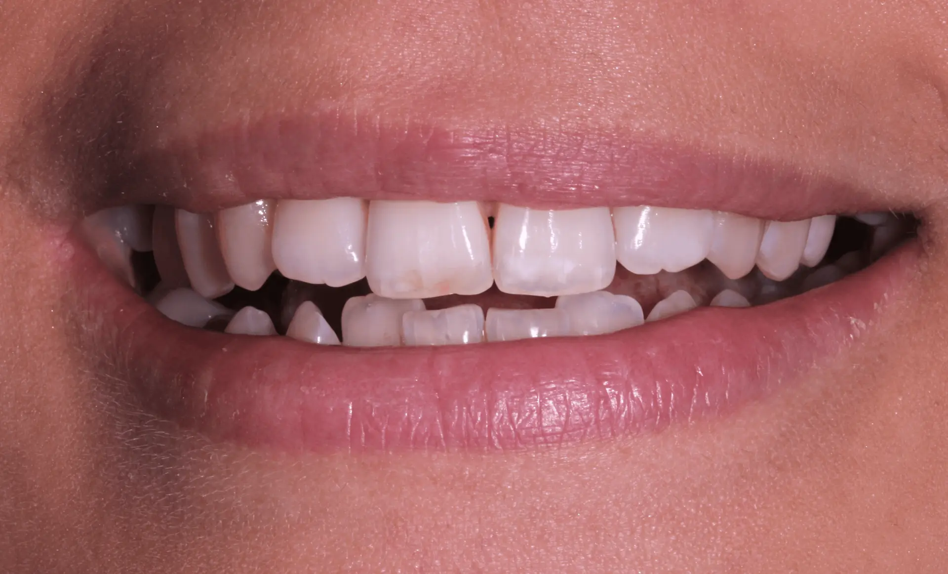 Visible gap between the front teeth before composite bonding