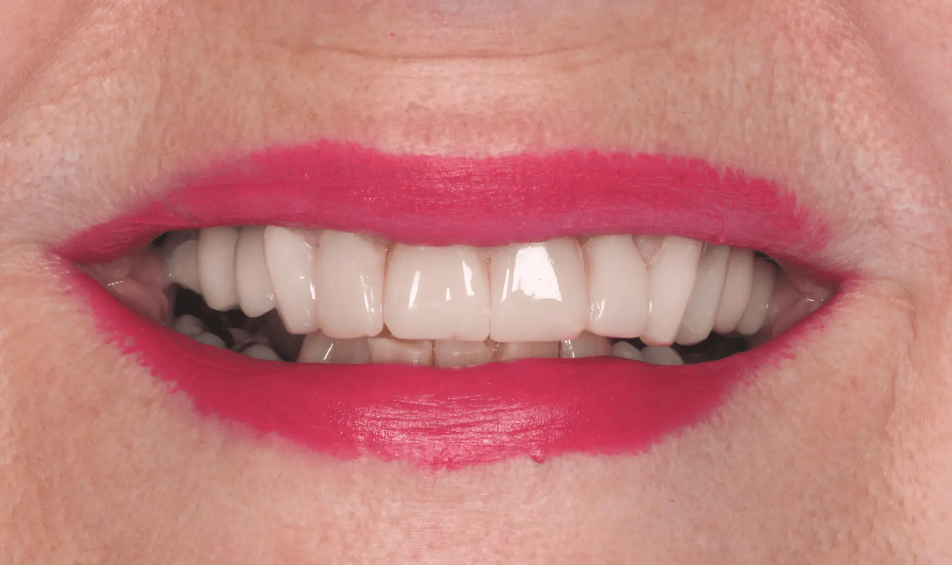 Cracks repaired and teeth restored after biomimetic treatment