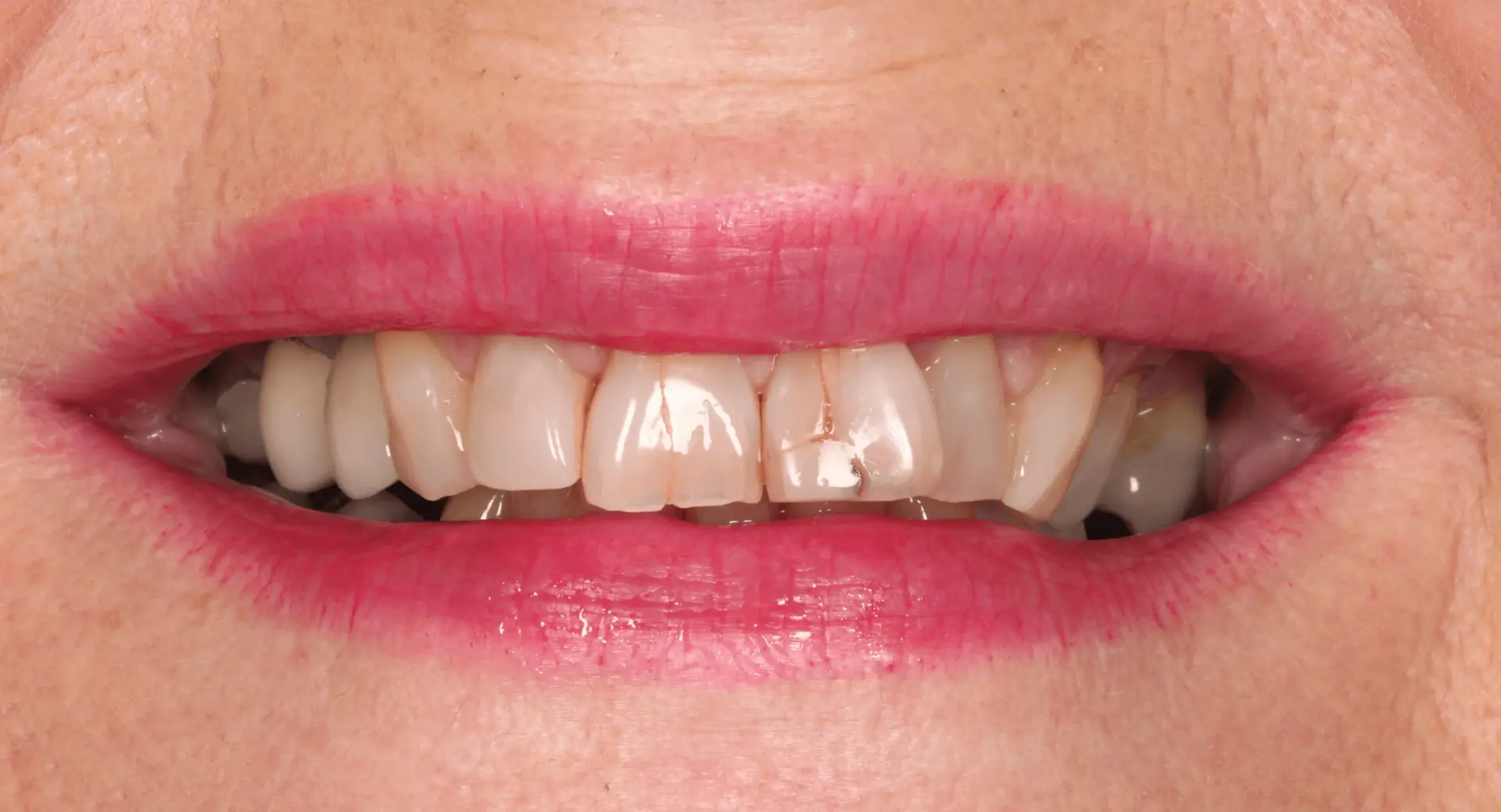 Cracked, stained front teeth before biomimetic restoration