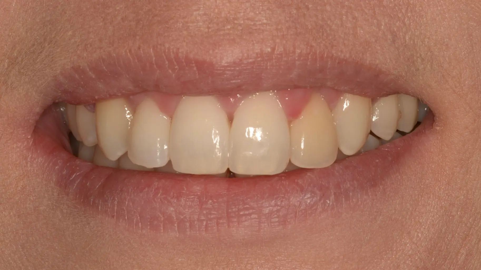 Reshaped, even front tooth after cosmetic treatment