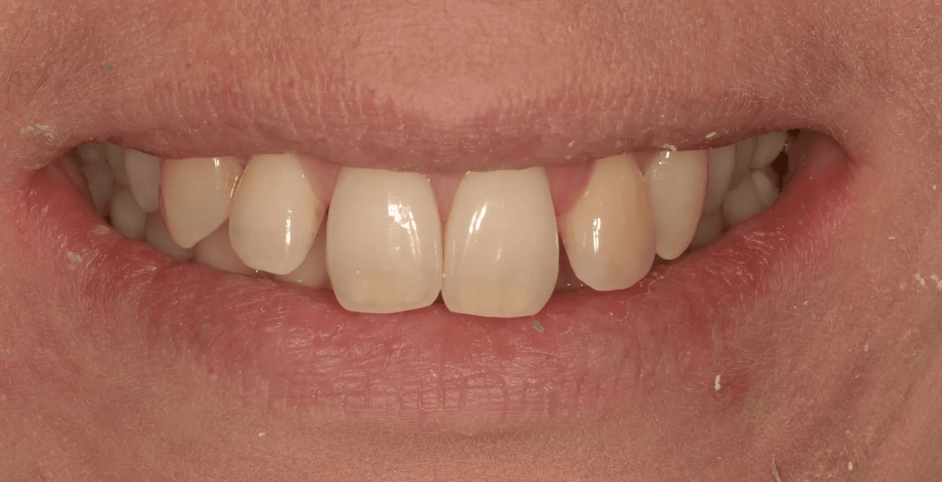 Chipped, uneven front tooth before cosmetic reshaping