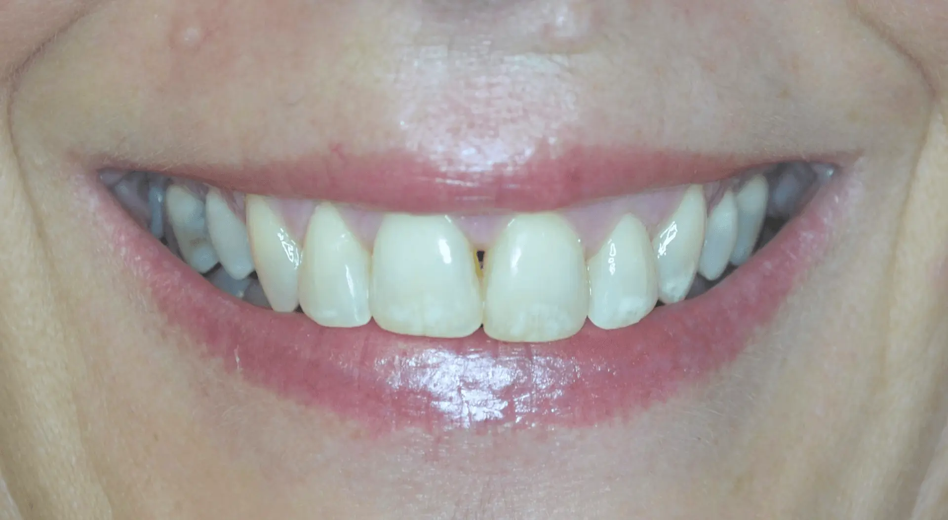 Reshaped, more even front teeth after cosmetic treatment