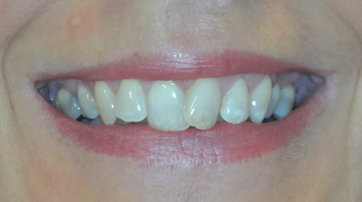 Worn, uneven front teeth before cosmetic reshaping