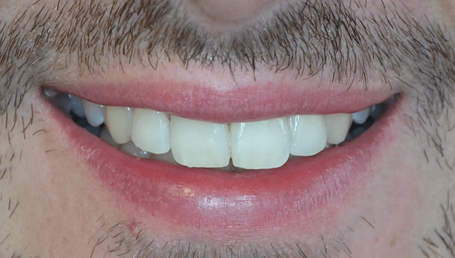 Straightened, aligned front teeth after treatment