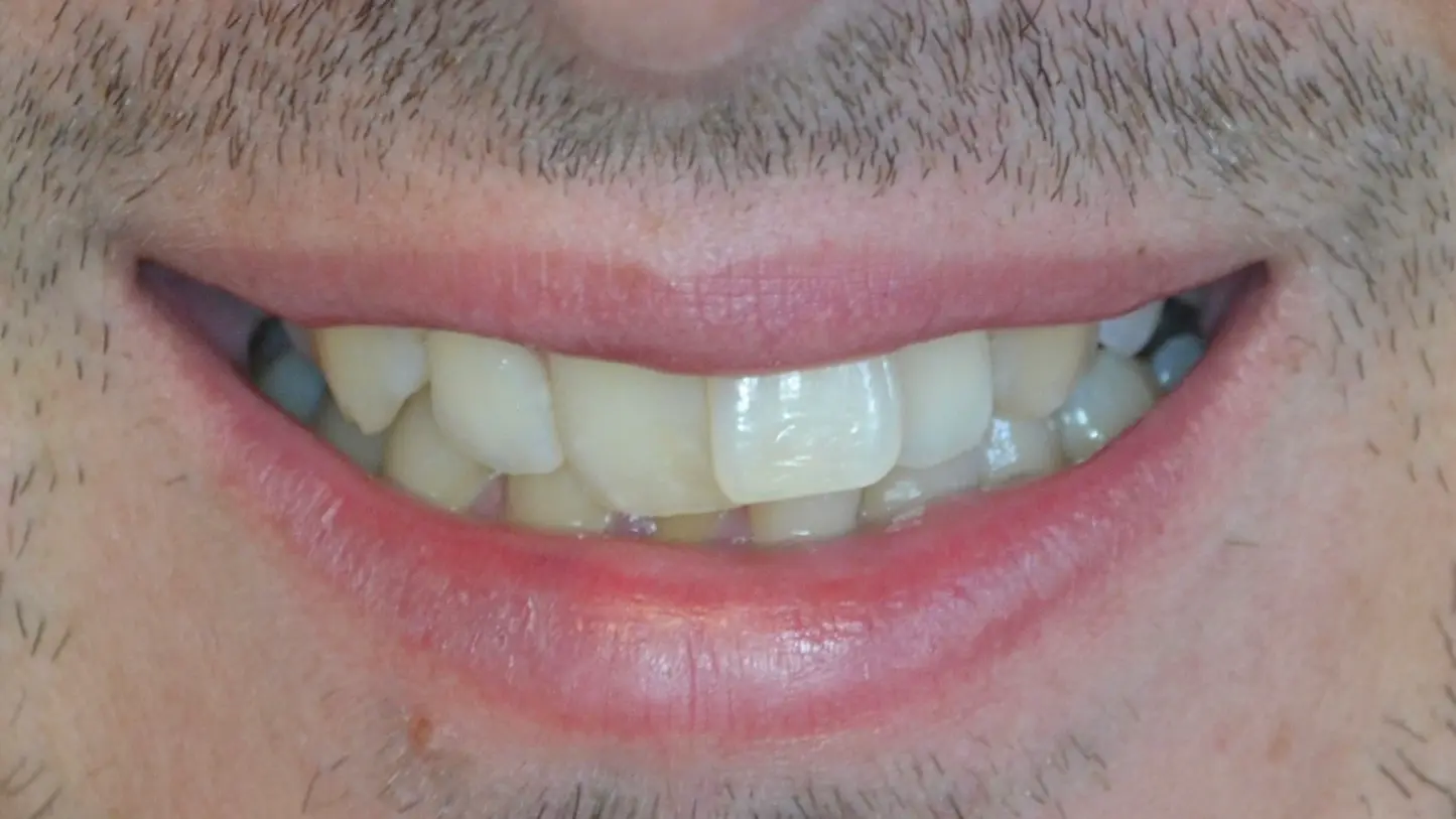 Rotated, misaligned front tooth before treatment