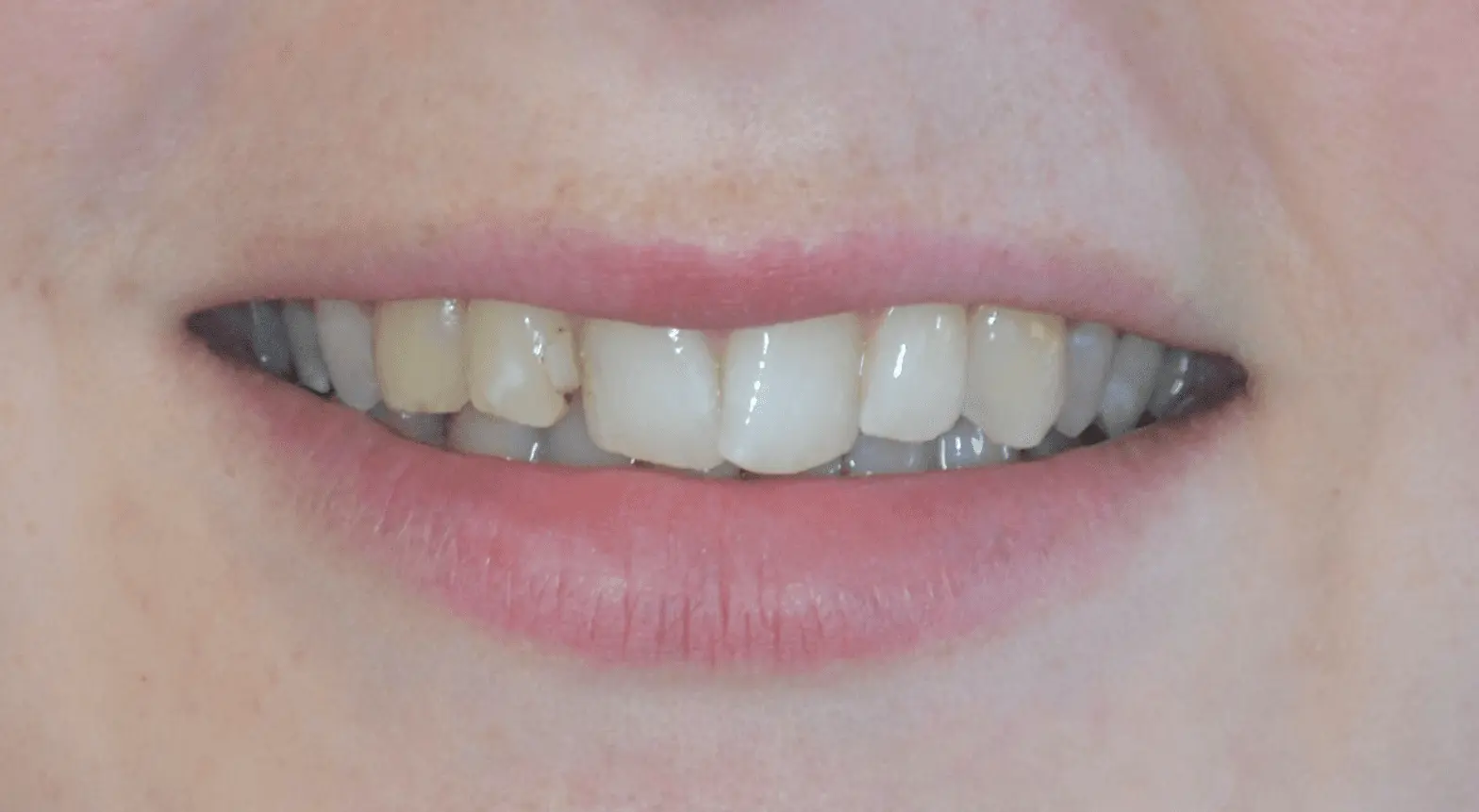 Chipped lateral incisor before cosmetic repair