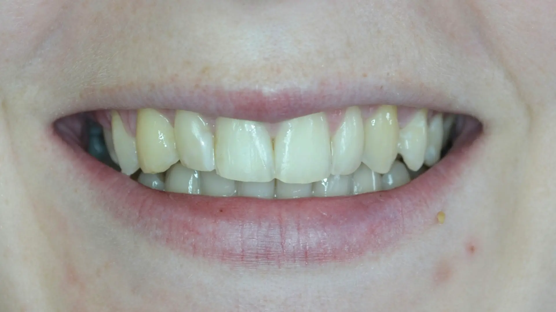 Repaired, even tooth edge after cosmetic treatment