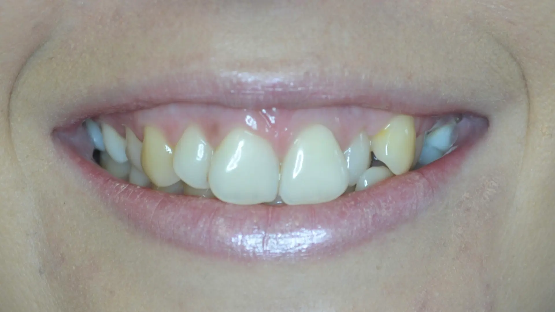 Discoloured, uneven teeth before cosmetic treatment