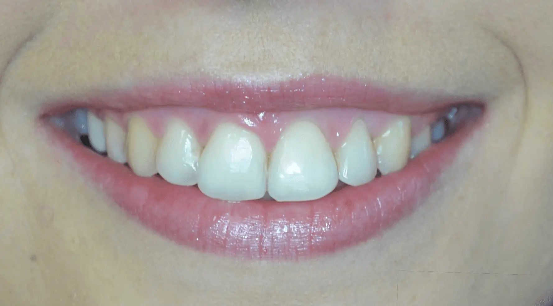 More even tooth shade and shape after cosmetic treatment