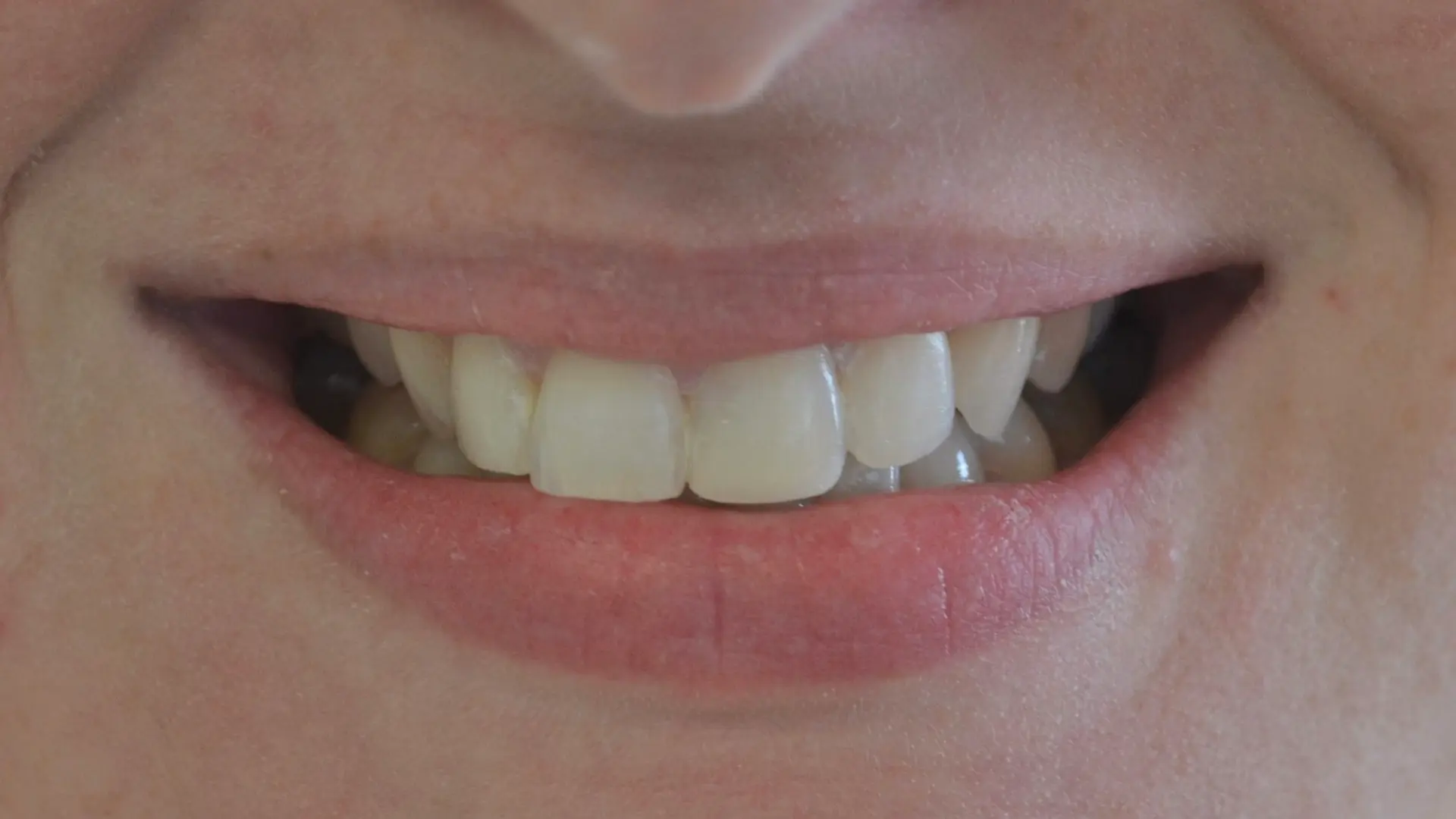 Reshaped, even front teeth after cosmetic treatment