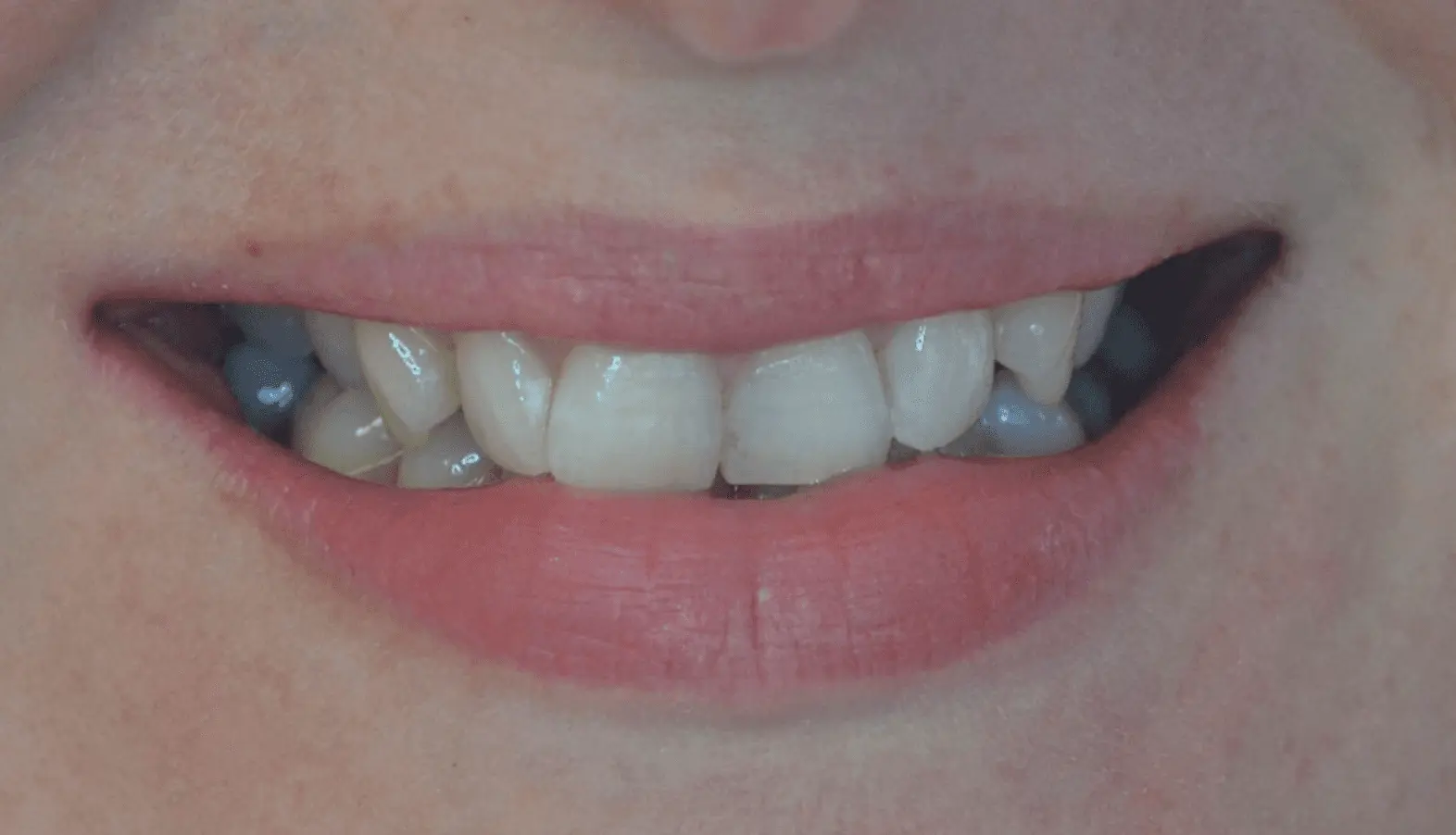 Worn, uneven front teeth before cosmetic reshaping