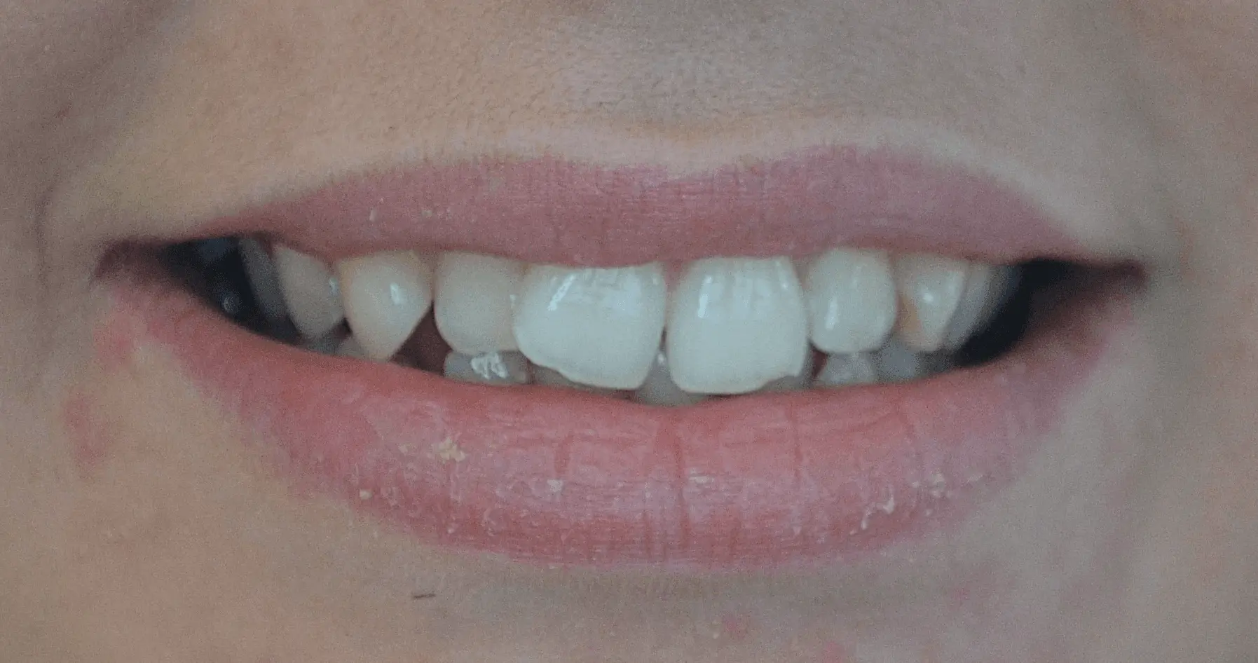 Cracked, notched front tooth before repair