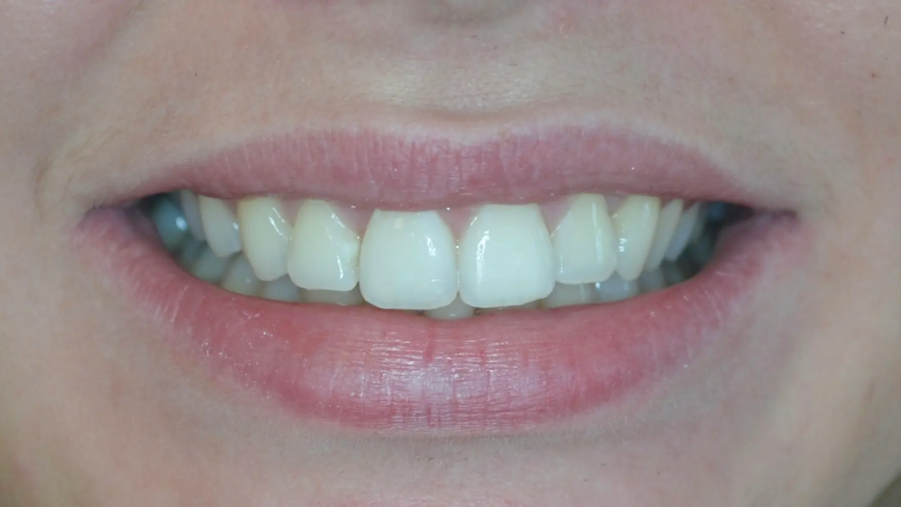 Repaired, smooth and even front tooth after treatment