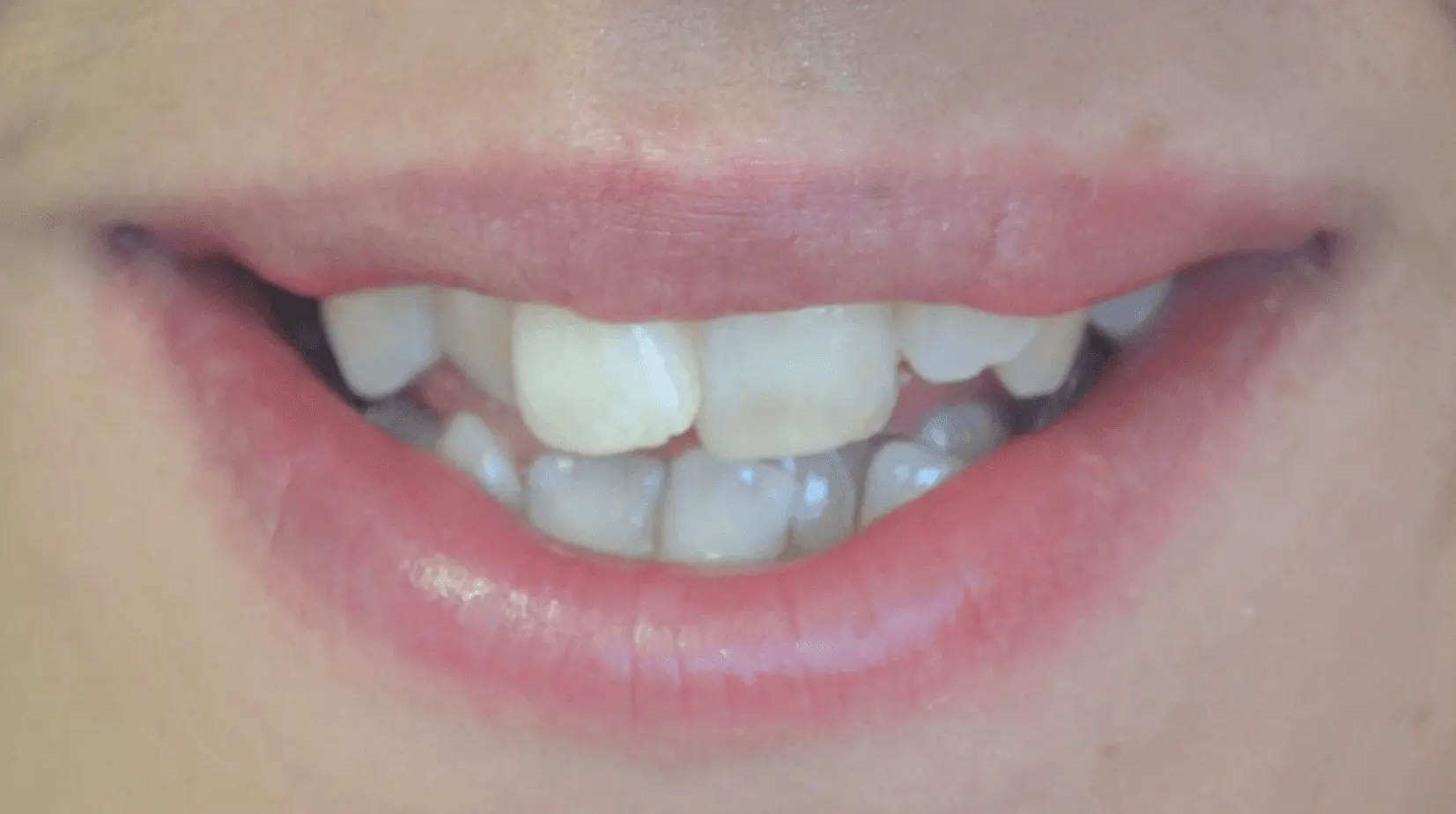 Chipped front tooth edge before cosmetic reshaping