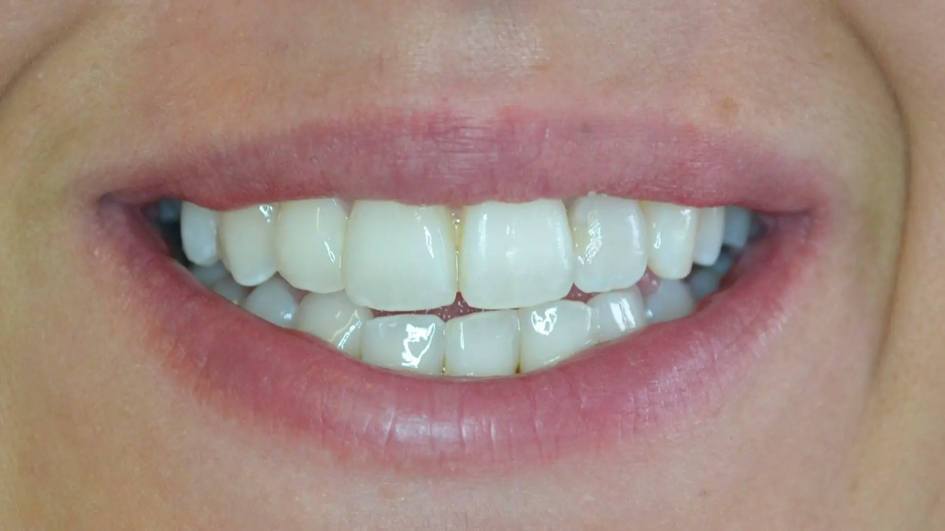 Reshaped, whiter and more even teeth after treatment