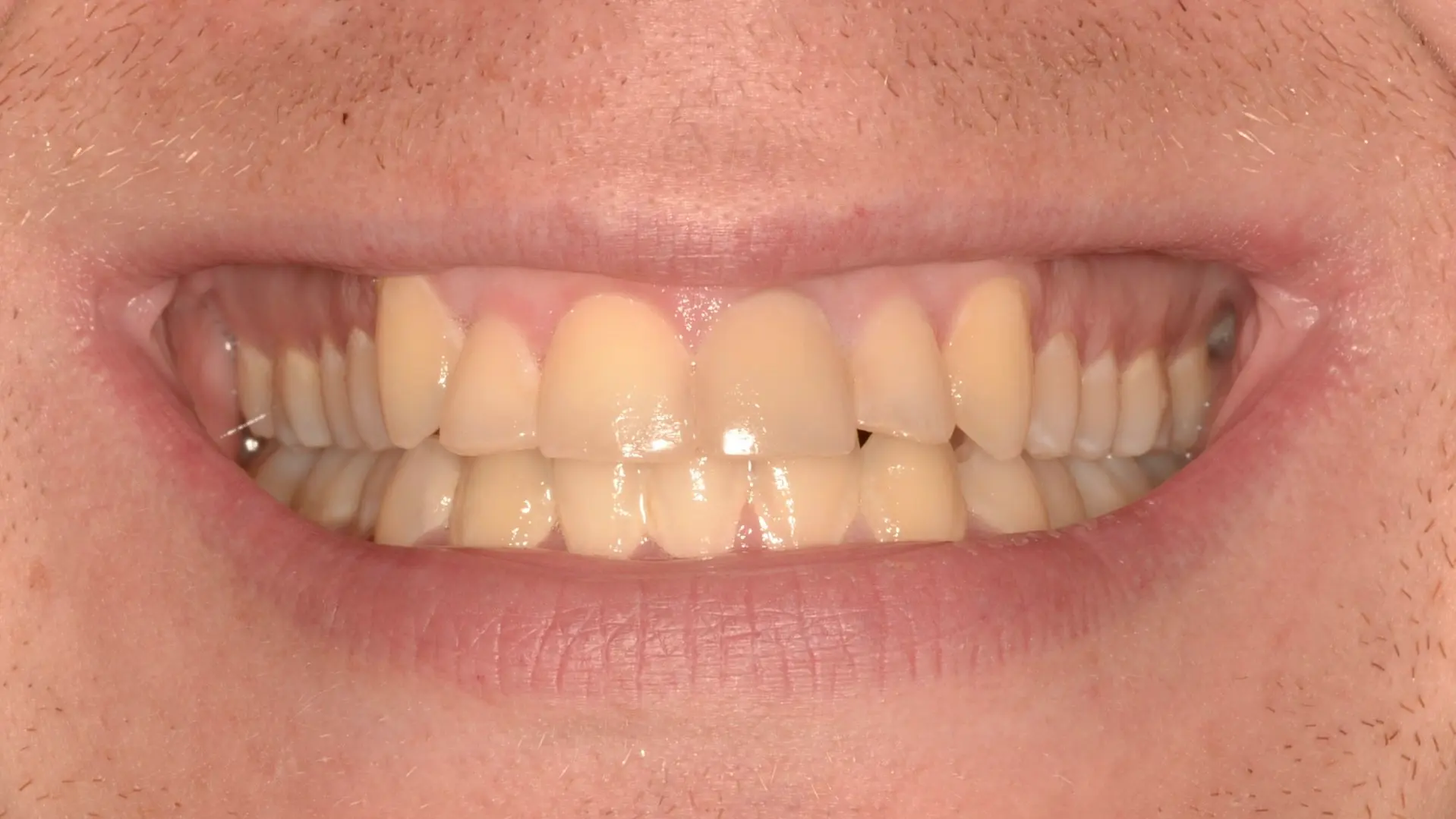 More evenly aligned teeth after treatment